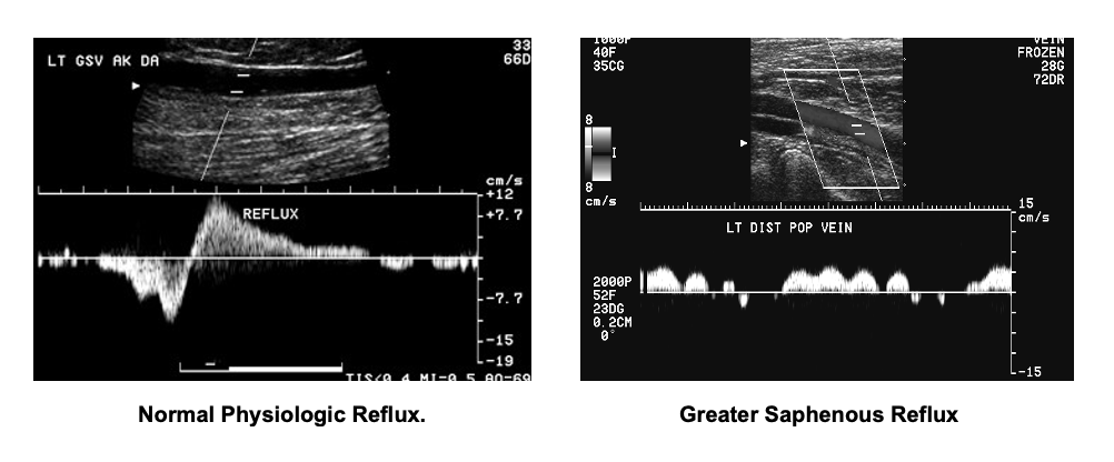 Venous Duplex Ultrasound is the Primary Imaging Modality for Reflux.